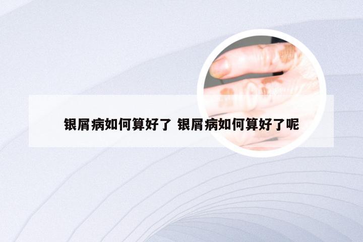 银屑病如何算好了 银屑病如何算好了呢