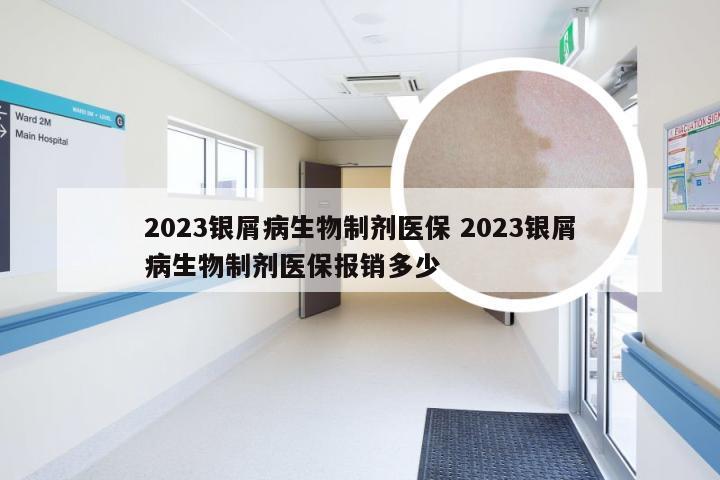 2023银屑病生物制剂医保 2023银屑病生物制剂医保报销多少