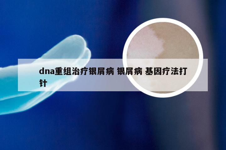 dna重组治疗银屑病 银屑病 基因疗法打针