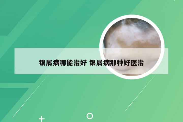 银屑病哪能治好 银屑病那种好医治