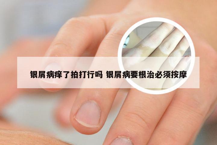 银屑病痒了拍打行吗 银屑病要根治必须按摩