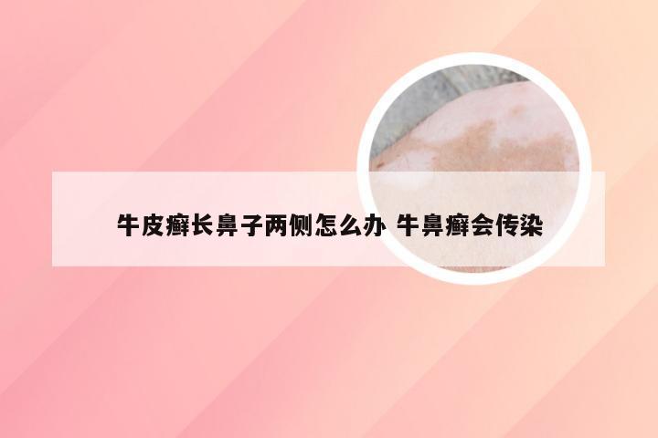 牛皮癣长鼻子两侧怎么办 牛鼻癣会传染