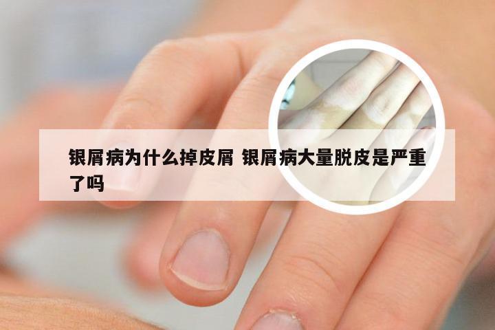 银屑病为什么掉皮屑 银屑病大量脱皮是严重了吗