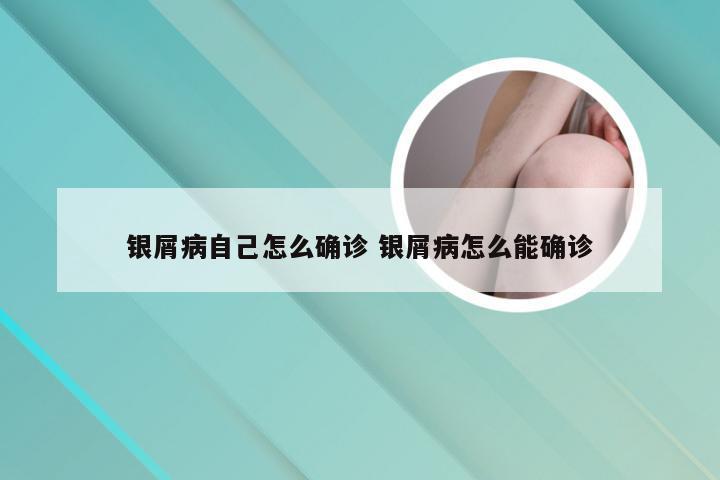 银屑病自己怎么确诊 银屑病怎么能确诊