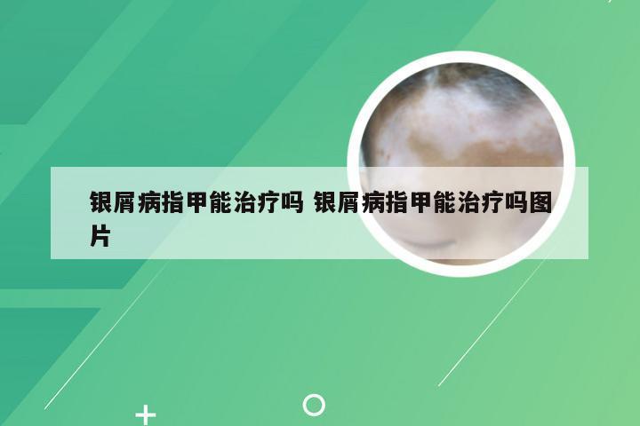 银屑病指甲能治疗吗 银屑病指甲能治疗吗图片