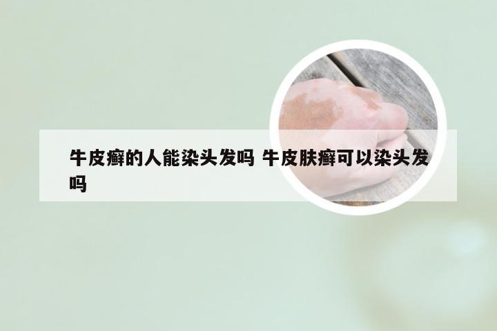 牛皮癣的人能染头发吗 牛皮肤癣可以染头发吗