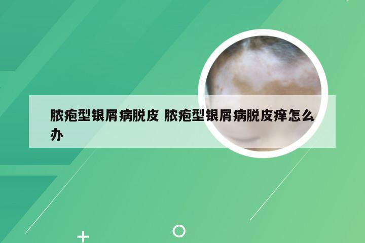 脓疱型银屑病脱皮 脓疱型银屑病脱皮痒怎么办