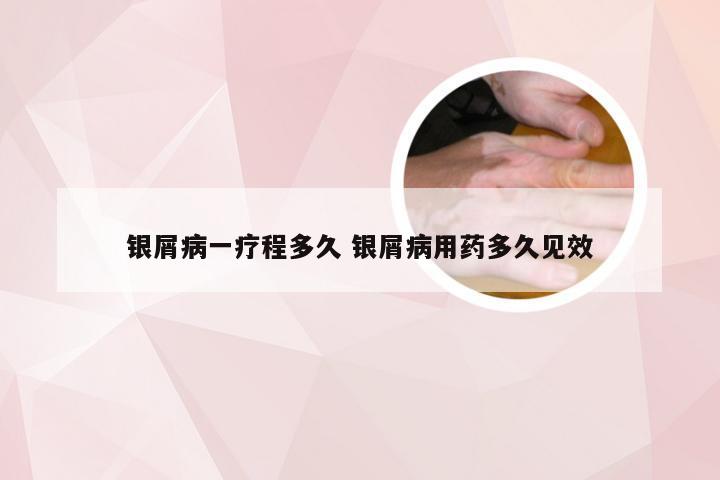 银屑病一疗程多久 银屑病用药多久见效