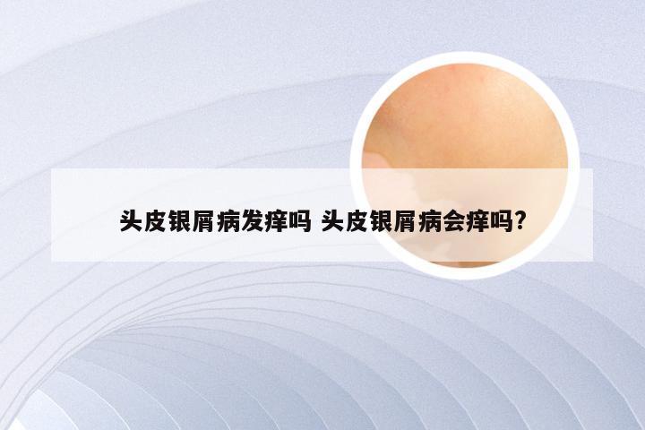 头皮银屑病发痒吗 头皮银屑病会痒吗?