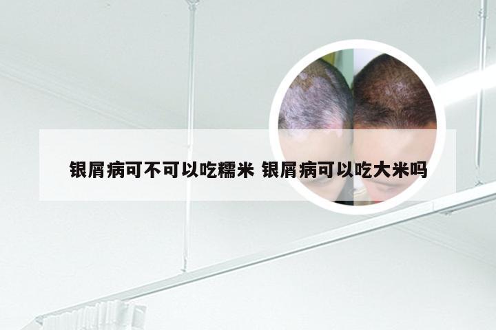 银屑病可不可以吃糯米 银屑病可以吃大米吗