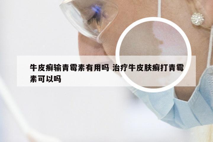 牛皮癣输青霉素有用吗 治疗牛皮肤癣打青霉素可以吗