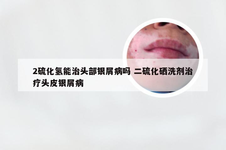 2硫化氢能治头部银屑病吗 二硫化硒洗剂治疗头皮银屑病