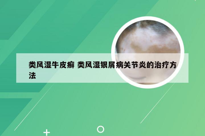 类风湿牛皮癣 类风湿银屑病关节炎的治疗方法