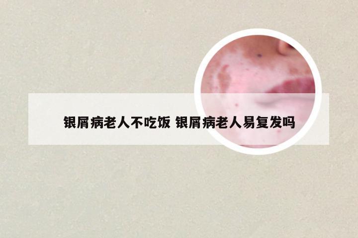 银屑病老人不吃饭 银屑病老人易复发吗