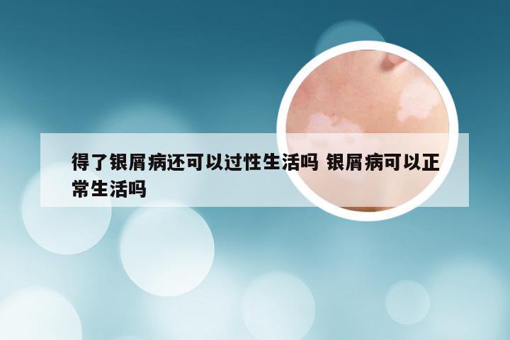 得了银屑病还可以过性生活吗 银屑病可以正常生活吗