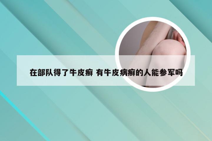 在部队得了牛皮癣 有牛皮病癣的人能参军吗