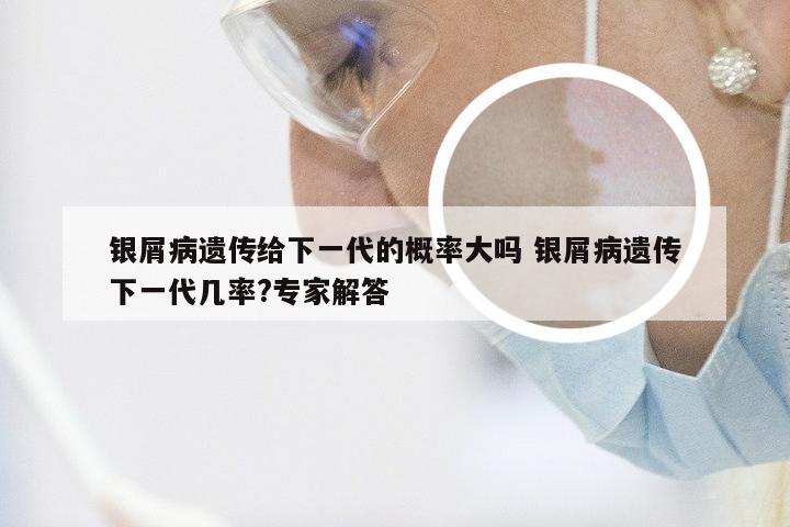 银屑病遗传给下一代的概率大吗 银屑病遗传下一代几率?专家解答