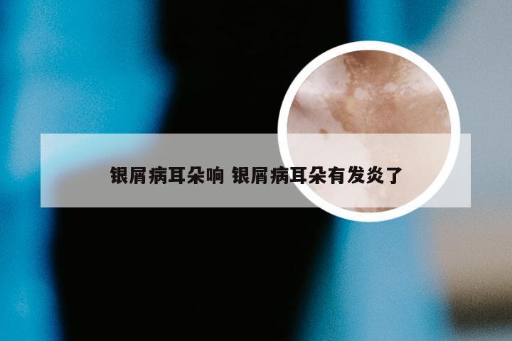 银屑病耳朵响 银屑病耳朵有发炎了