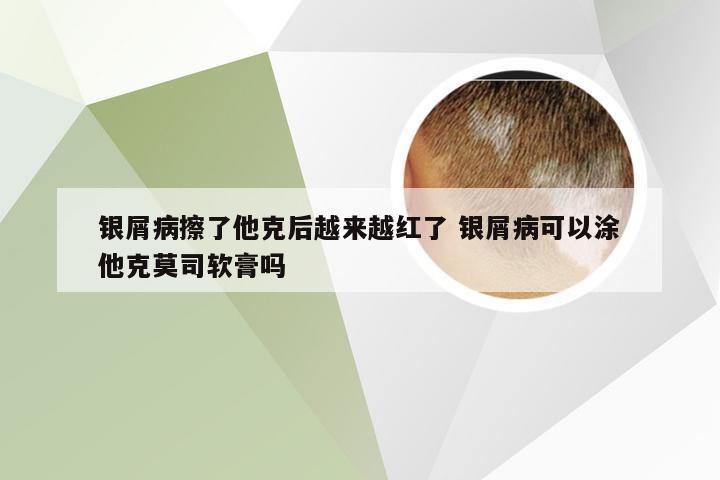 银屑病擦了他克后越来越红了 银屑病可以涂他克莫司软膏吗