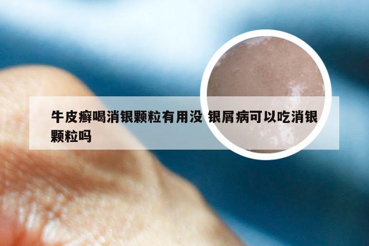 牛皮癣喝消银颗粒有用没 银屑病可以吃消银颗粒吗