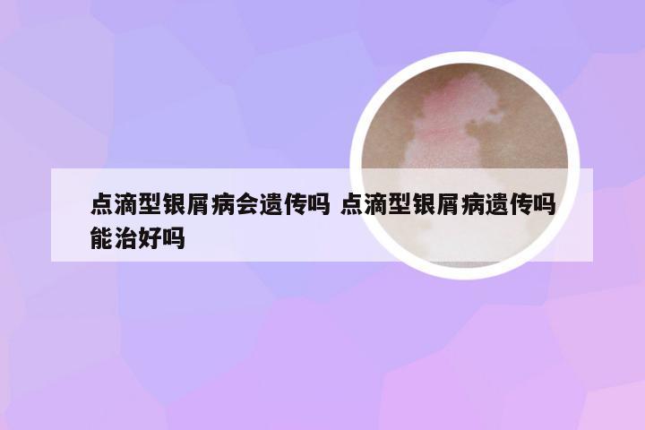 点滴型银屑病会遗传吗 点滴型银屑病遗传吗能治好吗