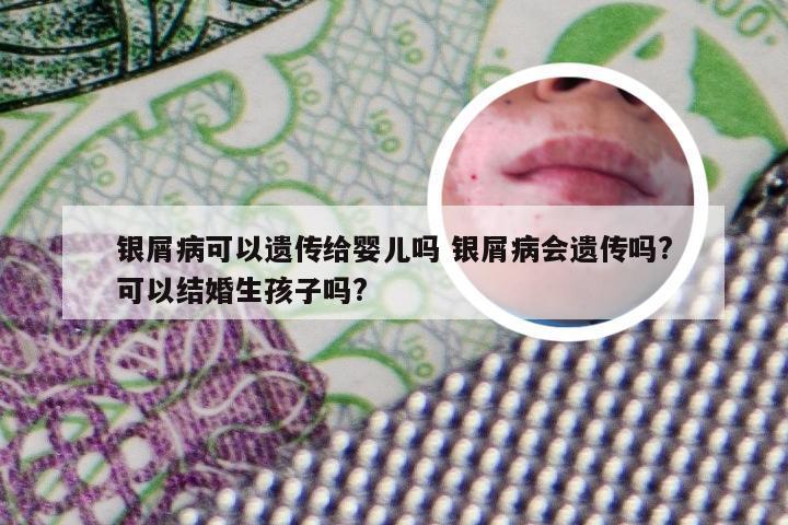 银屑病可以遗传给婴儿吗 银屑病会遗传吗?可以结婚生孩子吗?