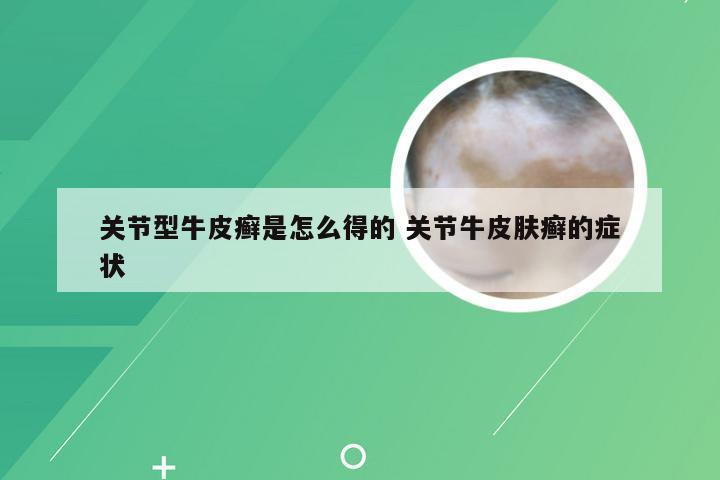 关节型牛皮癣是怎么得的 关节牛皮肤癣的症状