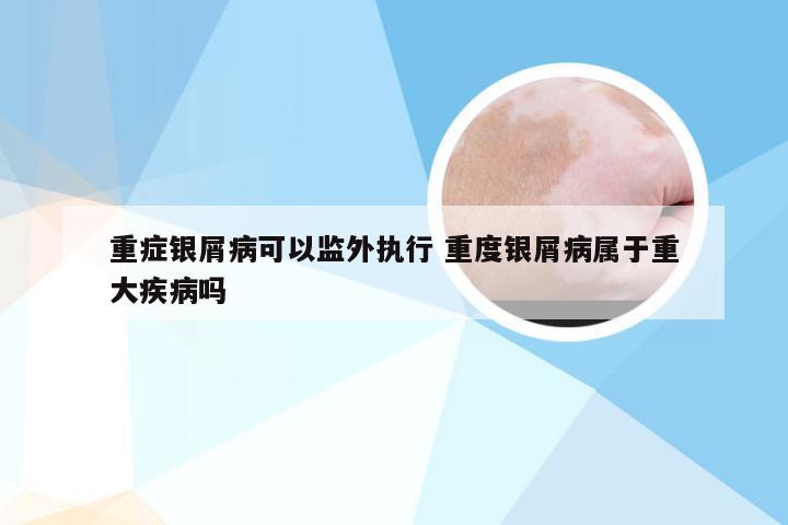 重症银屑病可以监外执行 重度银屑病属于重大疾病吗