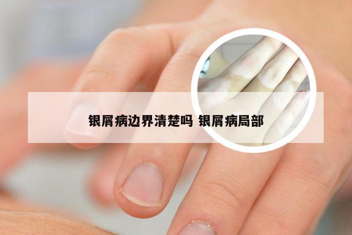 银屑病边界清楚吗 银屑病局部