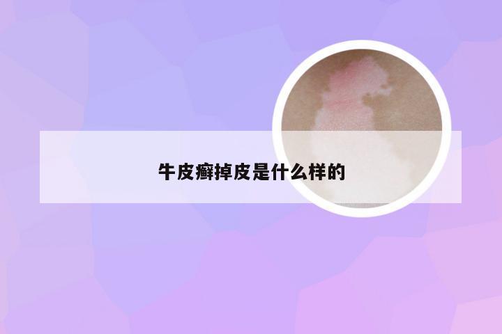 牛皮癣掉皮是什么样的