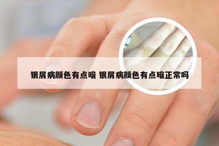 银屑病颜色有点暗 银屑病颜色有点暗正常吗