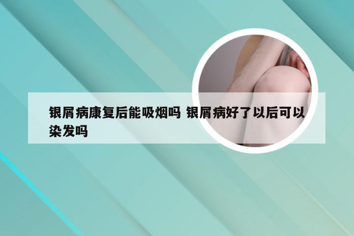 银屑病康复后能吸烟吗 银屑病好了以后可以染发吗