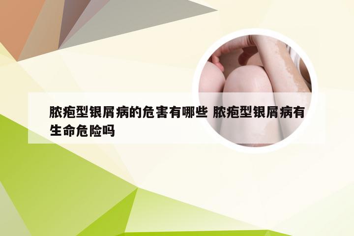 脓疱型银屑病的危害有哪些 脓疱型银屑病有生命危险吗