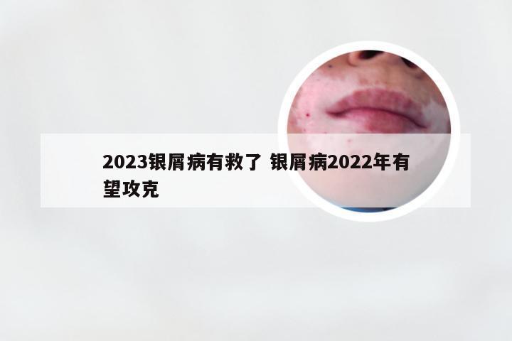 2023银屑病有救了 银屑病2022年有望攻克