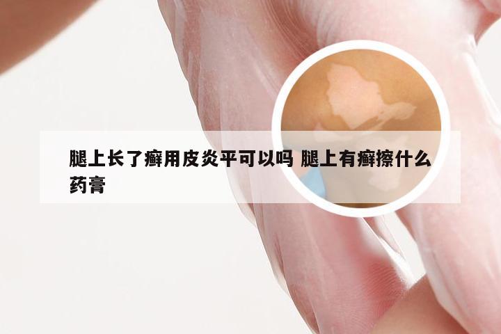 腿上长了癣用皮炎平可以吗 腿上有癣擦什么药膏