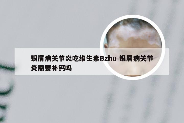 银屑病关节炎吃维生素Bzhu 银屑病关节炎需要补钙吗