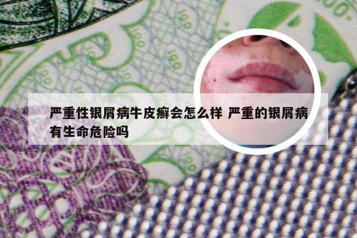 严重性银屑病牛皮癣会怎么样 严重的银屑病有生命危险吗