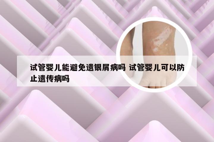 试管婴儿能避免遗银屑病吗 试管婴儿可以防止遗传病吗