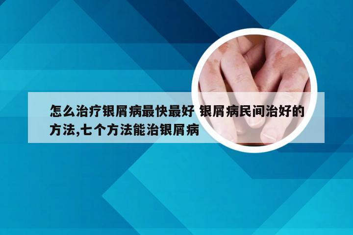 怎么治疗银屑病最快最好 银屑病民间治好的方法,七个方法能治银屑病