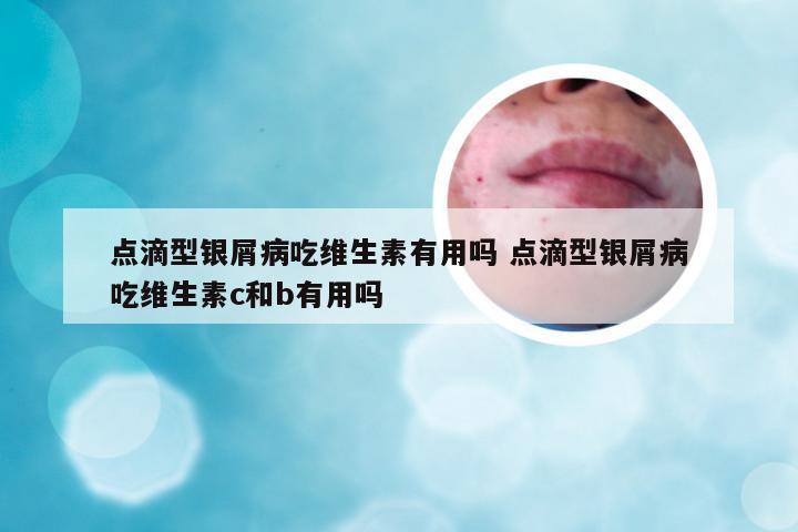 点滴型银屑病吃维生素有用吗 点滴型银屑病吃维生素c和b有用吗