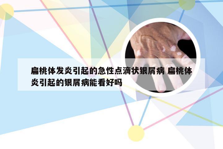 扁桃体发炎引起的急性点滴状银屑病 扁桃体炎引起的银屑病能看好吗