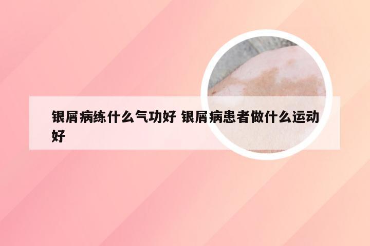 银屑病练什么气功好 银屑病患者做什么运动好