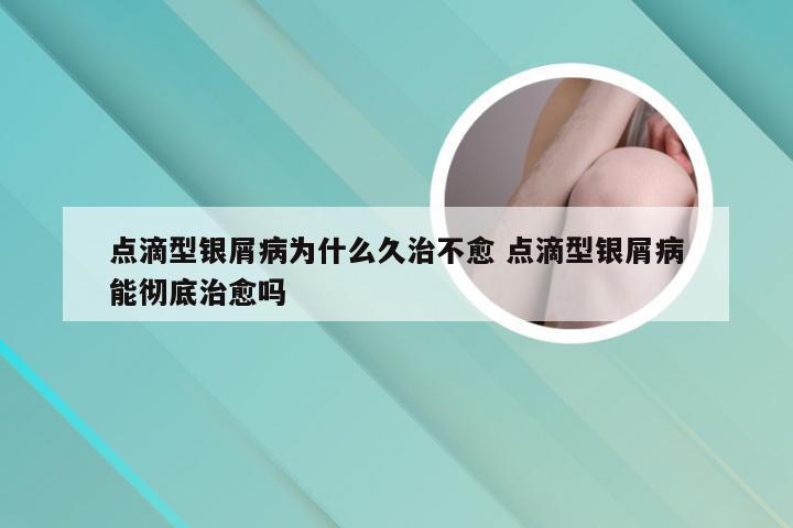 点滴型银屑病为什么久治不愈 点滴型银屑病能彻底治愈吗