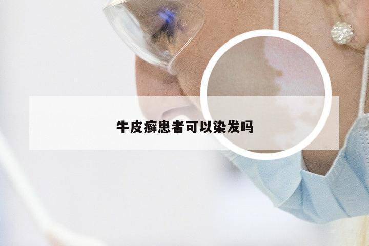 牛皮癣患者可以染发吗