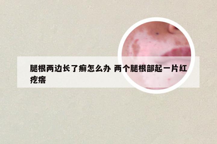 腿根两边长了癣怎么办 两个腿根部起一片红疙瘩