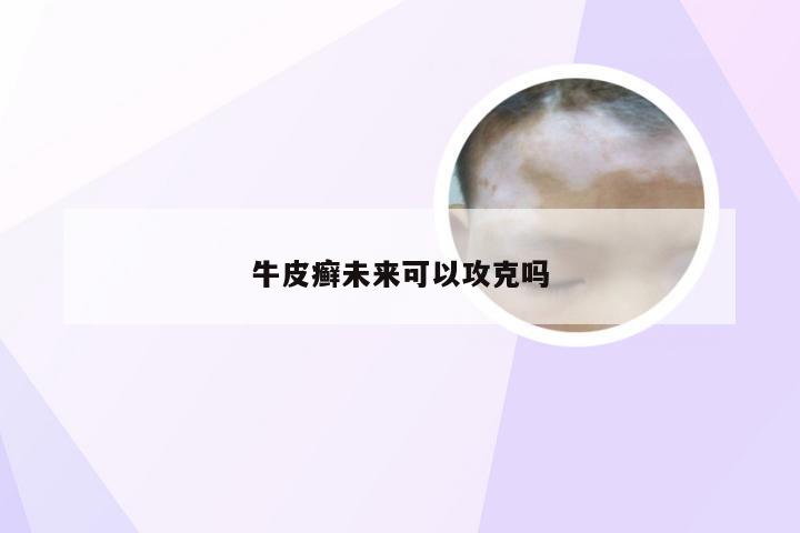 牛皮癣未来可以攻克吗