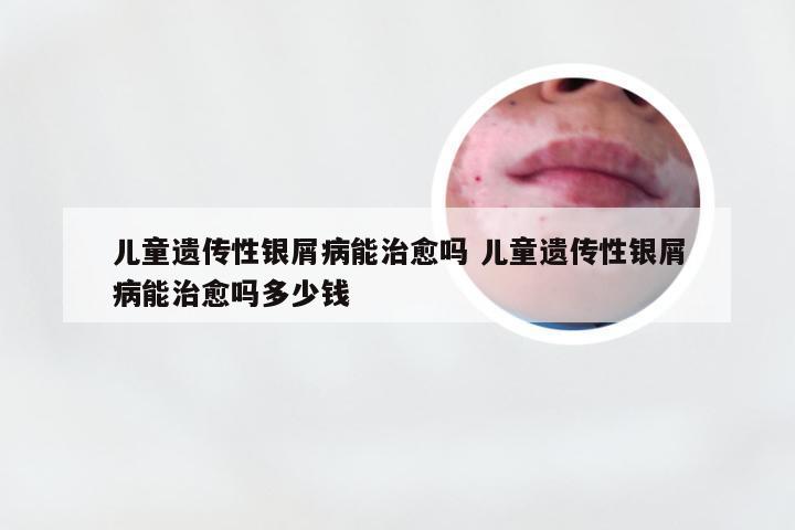 儿童遗传性银屑病能治愈吗 儿童遗传性银屑病能治愈吗多少钱