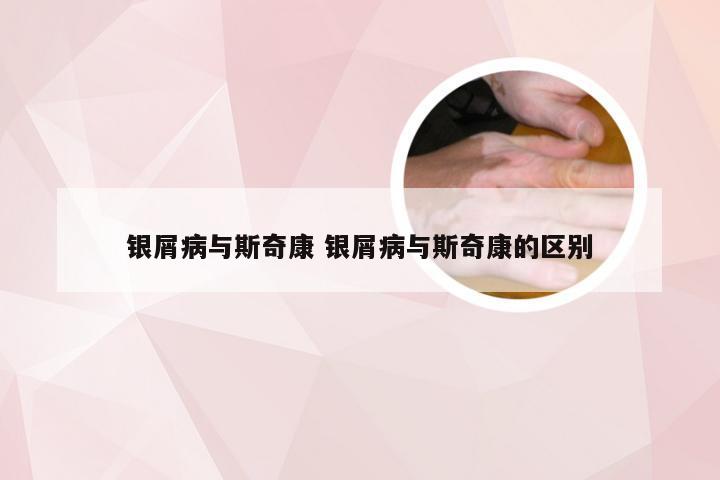 银屑病与斯奇康 银屑病与斯奇康的区别