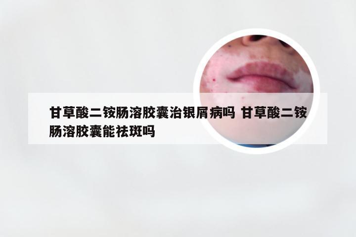 甘草酸二铵肠溶胶囊治银屑病吗 甘草酸二铵肠溶胶囊能祛斑吗