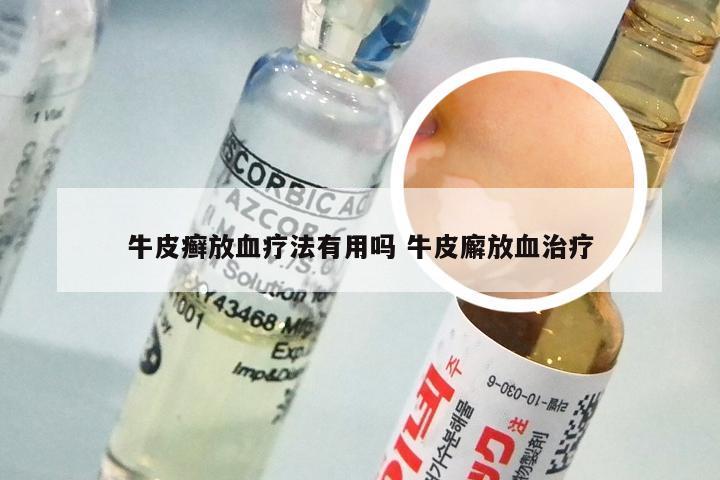 牛皮癣放血疗法有用吗 牛皮廨放血治疗